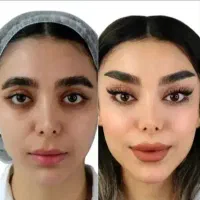 بسته های طلایی فیلر لب گونه زاویه بوتاکس توسط پزشک