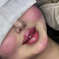 تزریق تخصصی فیلروبوتاکس و آنزیم توسط پزشک|خدمات آرایشگری و زیبایی|کرمانشاه, |دیوار