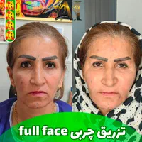 تزریق فیلر بادی ،ساکشن، تزریق چربی صورت و بدن|خدمات آرایشگری و زیبایی|صدرا-فارس, |دیوار