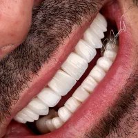 دندان مصنوعی در یک جلسه تحویل1روز ، کامپوزیت دندان