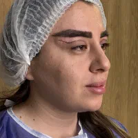 بلفاروپلاستی تضمینی تزریق فیلر بوتاکس و لیزر اقساط|خدمات آرایشگری و زیبایی|تبریز, |دیوار