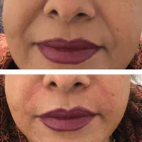 تزریق ژل وبوتاکس،پریسنگ،ارایش دائمصورت تاتوکل صورت|خدمات آرایشگری و زیبایی|گنبد کاووس, |دیوار