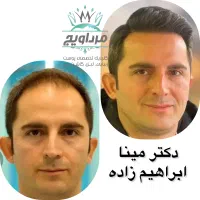 جشنواره کاشت مو و ابرو کلینیک مرداویج ویژه نوروز