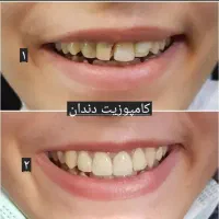 تخفیف وام دندانپزشکی ایمپلنت کامپوزیت روکش عصب کشی|خدمات آرایشگری و زیبایی|بروجرد, |دیوار