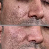 برداشت خال ،زیگیل،کک و مک،پاک کردن تتو در کیلینیک|خدمات آرایشگری و زیبایی|کرمانشاه, |دیوار
