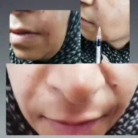 ژل و بوتاکس|خدمات آرایشگری و زیبایی|قم, باجک یک|دیوار