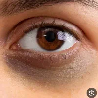 سیاهی وگودی دور چشم