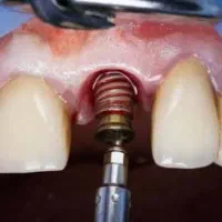 تخفیف ویژه ایمپلنت با شرایط اقساط توسط جراح