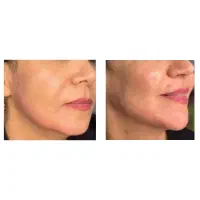 ژل ،فیلر بوتاکس