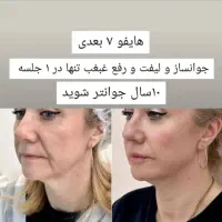 مرکز تخصصی هایفو پاک کردن تتوابرو بالیزر توسط پزشک|خدمات آرایشگری و زیبایی|مرودشت, ابوذر شمالی|دیوار