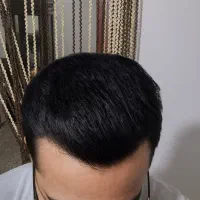 کاشت مو با ضمانتنامه کتبی