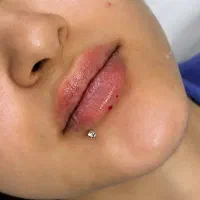 جشنواره بوتاکس و فیلر و لیزر|خدمات زیبایی و سلامت|اصفهان, فرهنگیان|دیوار