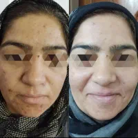 فقط با490تومن حذف لک جای جوش ومنافذباز زیرنظرمتخصص