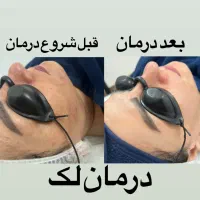 پاکسازی پوست به صورت حرفه ای فقط ۴۰۰ت|خدمات آرایشگری و زیبایی|قائمشهر, |دیوار