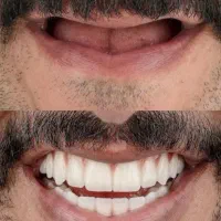 ایمپلنت.عصب کشی.روکش.کامپوزیت