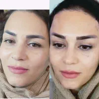 دایرکت ابرو لیفت شقیقه جراحی ۸.بوتاکس مصپورت ۶۰۰|خدمات آرایشگری و زیبایی|مشهد, شهید فرامرز عباسی|دیوار