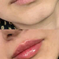 ژل و بوتاکس