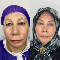 جشنواره بلفاروپلاستی جراحی پلک با بخیه زیرپوستی