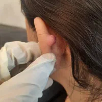 لیزرودرمان زگیل تناسلیhpvخال میخچه،ضایع پوست لک|خدمات آرایشگری و زیبایی|کرج, گلشهر|دیوار