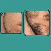 پر پشت شدن ناحیه فک و گونه