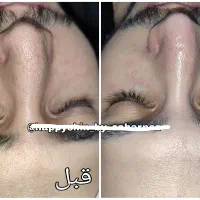 مدل فیشیال وی ای پی و درمان جوش|خدمات آرایشگری و زیبایی|تهران, مجیدیه|دیوار