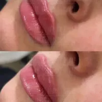 ژل بوتاکس نخ لیفت مزو زاویه|خدمات آرایشگری و زیبایی|تهران, سلسبیل|دیوار