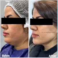 تخفیف لیپو ۳۶۰ + ابدومینو پلاستی در شیراز + وام