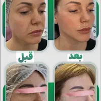 لیفت تخصصی صورت بانخ ،فرمدهی بینی ،لیفت ابرو شقیقه|خدمات آرایشگری و زیبایی|مشهد, احمدآباد|دیوار