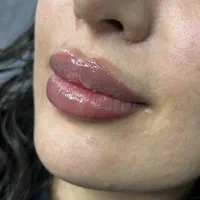 فیلر ژل لب با قیمت پاییز  - دکتر واحدی