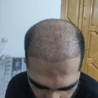 کاشت مو و ریش تحت نظر پزشک متخصص|خدمات آرایشگری و زیبایی|بابل, |دیوار