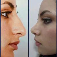 جراحی تیپ‌پلاستی بینی بصورت اقساط۱۸ ماهه|خدمات آرایشگری و زیبایی|خرم‌آباد, |دیوار
