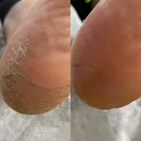 کفسابی و لای برداری پای بانوان