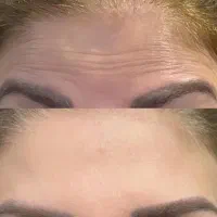 میکروبلیدینگ فیلرو بوتاکس شیدینگ تخفیف یلدایی|خدمات آرایشگری و زیبایی|بیرجند, |دیوار