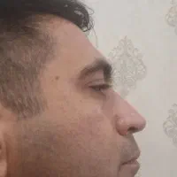 راهنمایی عمل بینی قیمت مناسب