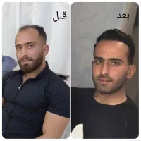 کاشت مو و ابرو تخصصی در کلینیک دیبا