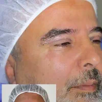 تخفیف ویژه عمل افتادگی پلک بلفاروپلاستی نقدو اقساط|خدمات آرایشگری و زیبایی|تهران, تهرانسر مرکزی|دیوار