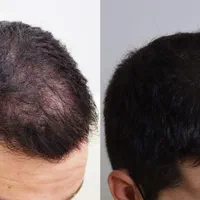 پی آر پی *بدون‌درد* prp قطع ریزش مو با ضمانت  365ت|خدمات آرایشگری و زیبایی|تبریز, |دیوار