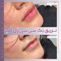 نیازمند مدل تزریقات زیبایی