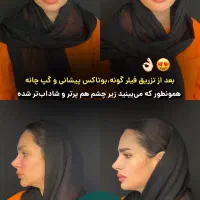 نیاز فوری به مانکن جهت تزریق بوتاکس و فیلر لب|خدمات آرایشگری و زیبایی|تهران, امانیه|دیوار