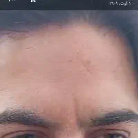 خال ولک وجوش زیر پوستی بدون درد