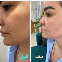 تخفیف استثنایی هایفوصورت،واژینال،کک،مک،درمان تیرگی|خدمات آرایشگری و زیبایی|تهران, هاشمی|دیوار