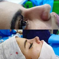 عمل بینی ساکشن غبغب ژل بوتاکس