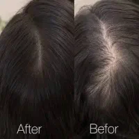 اسکالپ سر برای رفع کم پشتی مو ،شیدینگ لب،میکروابرو