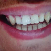 کامپوزیت زیبایی ( دو فک ۱۵ میلیون )