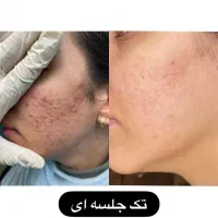 به مدل جهت انجام تکنیک آیینه سازی پوست|خدمات آرایشگری و زیبایی|ورامین, ورامین|دیوار