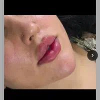 اموزش ژل و بوتاکس