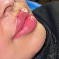 تزریق فیلر بدن وصورت فقط ۶۹۰۰ تخفیف۸۰درصدی|خدمات زیبایی و سلامت|تهران, صاحب الزمان|دیوار