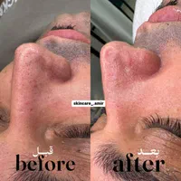 فیشیال تخصصی آقایان « پاکسازی پوست » فشیال فیشال|خدمات آرایشگری و زیبایی|مشهد, الهیه|دیوار