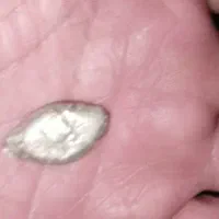 نقره ساچمه ای