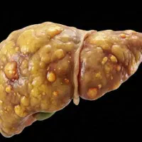 کبد چرب را نجات دهید